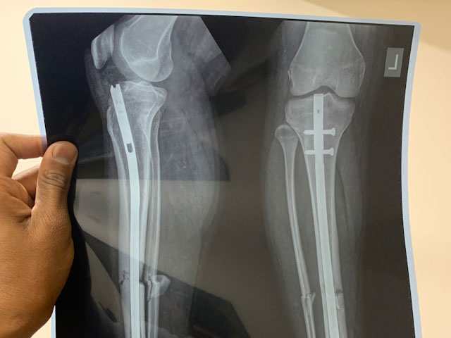 Person holding up an X-ray of calves with medical rods
